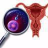 卵巢囊肿 卵巢囊肿是什么病
